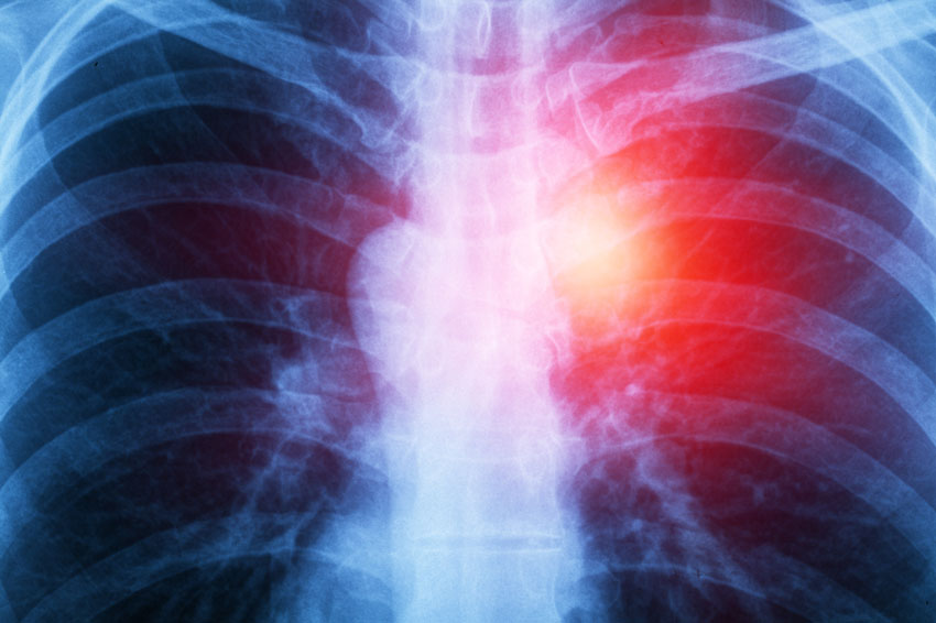 can asbestos cause heart valve problems